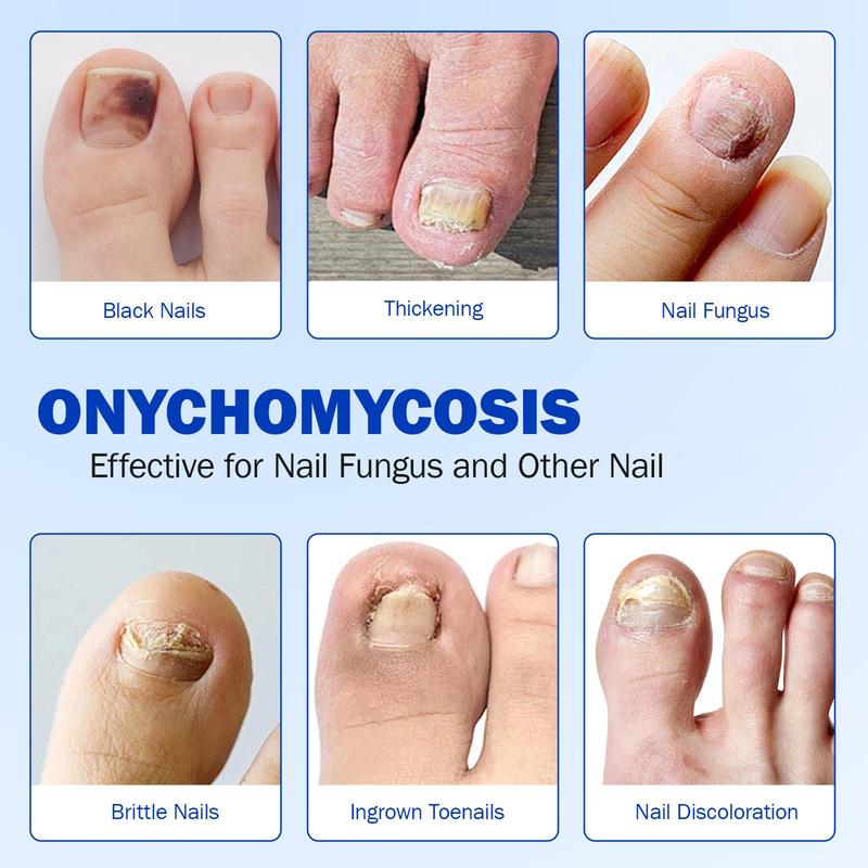 Fungal Nail Patches