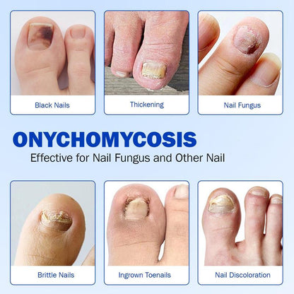Fungal Nail Patches