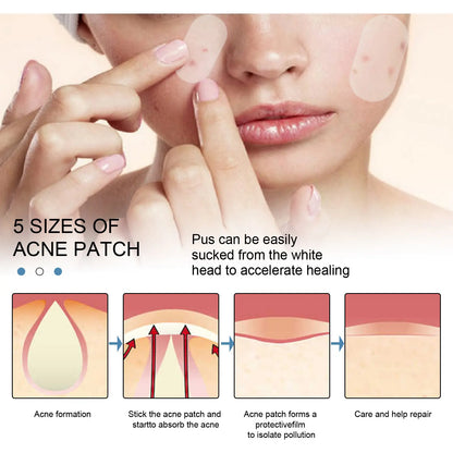 Large Pimple Patches
