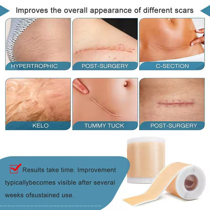 Silicone Scar Sheets